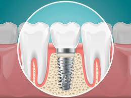 Having all your upper teeth remoed is a big procedure and you should expect to take several days to recouperate. What Is Tooth Extraction Bone Grafting Smile Angels Of Beverly Hills