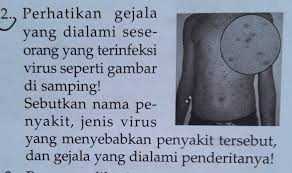 Sementara itu, gangguan pendengaran akibat penyakit ménière dapat diobati secara medis dengan diet rendah sodium, pemberian diuretik, dan kortikosteroid. Sebutkan Nama Penyakit Jenis Virusyang Menyebabkan Penyakit Tersebut Dan Gejala Yang Dialami Brainly Co Id