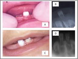Image result for Neonatal Teeth