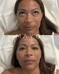 Luis Xavier Mayol Vélez, MD, MPH (@drmayol) • Instagram photos and videos