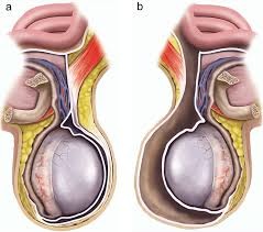 Before you embark on this conversation, have a discussion with your doctor. Surgery For Benign Scrotal Lumps Healthdirect