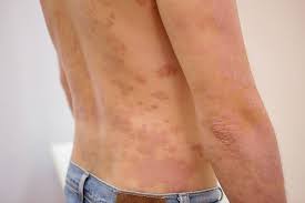 Ubat kuat lelaki yang diluluskan kkm ubat kuat lelaki malaysia price, harga; Psoriasis Eritroderma Gejala Sebab Obat Dll Hello Sehat