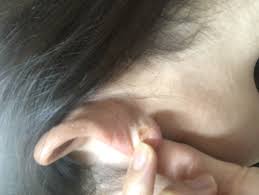 ピアス穴から出る分泌液について - 長文で失礼致します。 | Q&A - @cosme(アットコスメ)