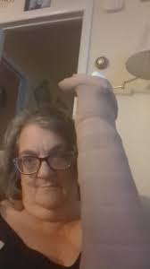 Broke hip and having surgery