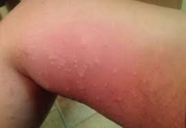 9 Thigh Rash Ideas Rashes Inner Thigh Rash Rash Causes