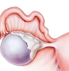 Occasionally they may produce bloating, lower abdominal pain, or lower back pain. Complex Ovarian Cyst Symptoms Risks Pictures Surgery