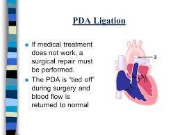 Pda stands for patent ductus arteriosis, which is a congenital failure of the heart to develop properly, leaving an opening between chambers that hinders blood flow. Patent Ductus Arteriosis Pda Ppt Video Online Download