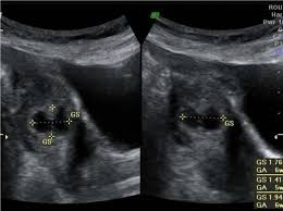 Here we have 11 photos about mengandung luar rahim including images, pictures, models, photos, and more. Kehamilan Ectopic Tanda Gejala Punca Diagnosis Rawatan Kehamilan 2021