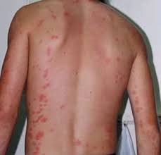 Bedbugs (or bed bugs) are small, oval, brownish insects that live on the blood of animals or humans. June 2010 Backpacking Who Says No Money Cannot Have Fun