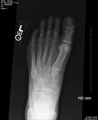 Foot X Ray Physical Therapist Physical Therapy Physics