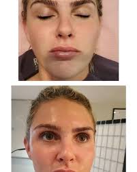 Lip Filler Services