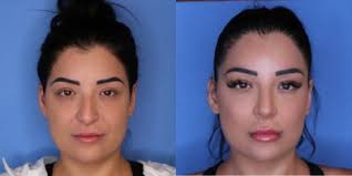 Thomas Romo, III, MD, Board Certified Facial Plastic Surgeon