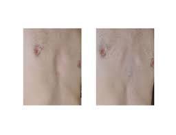 Image result for Pectus Excavatum