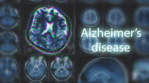 Learn about alzheimer's disease symptoms such as memory loss and senile dementia. Alzheimer S Foundation Of America What Is Alzheimer S Disease