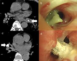 Image result for Broncholithiasis