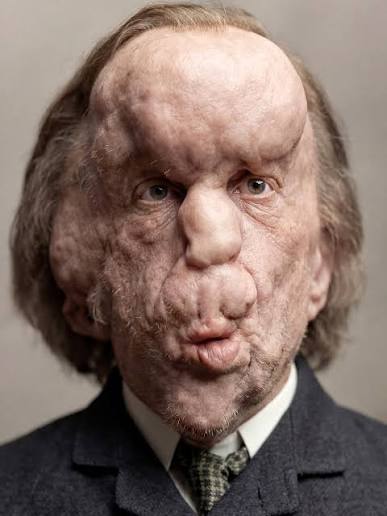 This portrait shows Joseph Merrick, photographed in the late 1880s. Known  to history as “The Elephant Man,” Merrick was born in 1862 in Leicester,  England, and lived with severe physical deformities