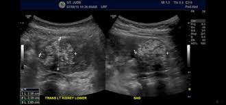 Some other symptoms of cancer in children might include fever, frequent infections, bone pain, night sweats, vomiting, and headaches, all of which children often have when they have more common and less serious viral infections or other common problems of childhood. Atypical Teratoid Rhabdoid Tumor At Rt In Children Together