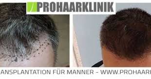 haartransplantation vorher nachher b credit history small business credit cards credit record