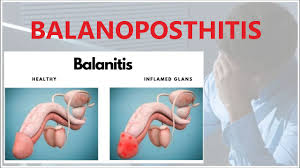 Image result for balanoposthitis