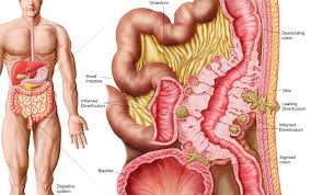 Diverticular Disease Diverticulosis And Diverticulitis