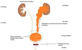 What Is Severe Fetal Hydronephrosis Fetal Kidney Failure Bladder