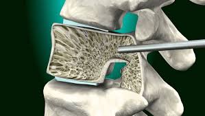 Image result for Vertebral Compression Fracture