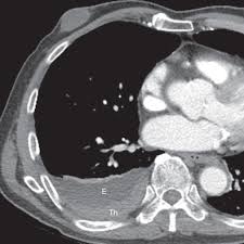 Maybe you would like to learn more about one of these? Pleural Neoplasms Radiology Key