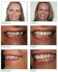 Pin On Six Month Smiles Results Before And After