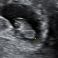 The aims of this scan are to determine the number of embryos present and whether the pregnancy is progressing normally inside the uterus. Dating Specialists In Pregnancy Ultrasounds And Gynecological Diagnosis