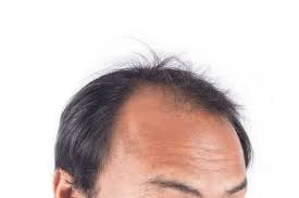 If you feel that you might be suffering from alopecia it is better to contact a dermatologist. Male Pattern Baldness Treatment Cure Stop Hair Loss In Men