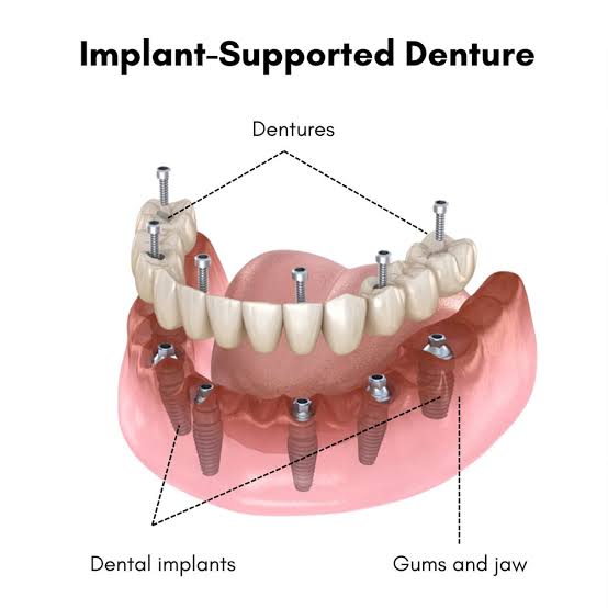 Implant-Supported Denture: A Permanent Solution for Loose Dentures