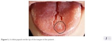 Image result for papillomavirus tongue)