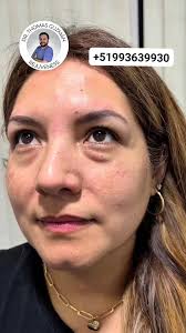 💉✨ Resultados naturales en solo 30 minutos., Los puntos de anclaje con  ácido hialurónico redefinen tu rostro con un efecto lifting sutil, sin  cirugía y con resultados inmediatos., Solo en manos de un ...