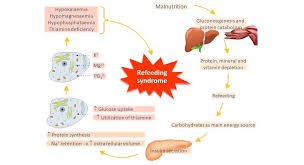 Image result for Refeeding Syndrome