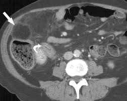 We did not find results for: Acute Epiploic Appendagitis And Its Mimics Radiographics