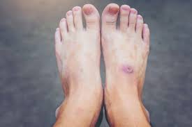 Image result for diabetic toes