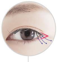 Minimal incision method through a small incision, unnecessary fat is removed and double twinkling crystal eyelid surgery, eye bag surgery korea. Canthoplasty Eyelid Surgery Canthoplasty Surgery Before And After Cost In Korea Mine Clinic