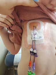 Dressing change #2 went really well. Of course there was pain but Kiki handled it super awesome. The dead skin is sloughing off and the burn is looking good. We still aren't