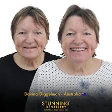 Tracy Jacobson travelled from Australia 🇦🇺 with a dream to India 🇮🇳— to  rediscover her lost smile. We helped her achieve that and more with a  flawlessly designed smile makeover using Premium