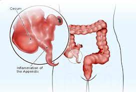Truly living up to its name, the appendix can be surgically removed without impairing the body's overall health. Appendicitis Symptoms Signs Causes Appendectomy In Detail