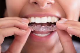 Le mascherine per denti invisibili sono la nuova frontiera dell'ortodonzia: Mascherine Trasparenti L Apparecchio Dentale Che C E Ma Non Si Vede