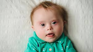 Yargıtay'dan down sendromlu çocukların ailelerini yakından ilgilendiren  karar