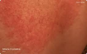 Image result for sweat rash on back