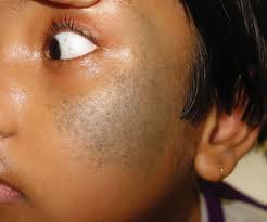 Image result for nevus sclerae
