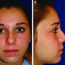 A): Pre operative lateral view shows exposed bone and fracture with...