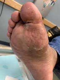 Image result for toe amputation