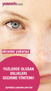 Yuzde Olusan Delik Ve Cukurlar Nasil Gecer Yuzde Delik Neden Olur Yuzler Sivilce Izi Genetik