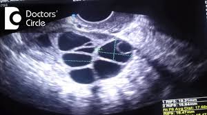 What Is The Ideal Size Of Mature Follicle For Infertility Treatment Dr Punyavathi C Nagaraj Youtube