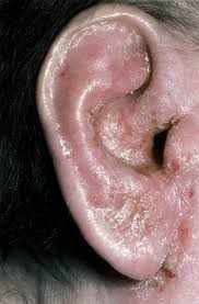 Image result for Acute Otitis Externa