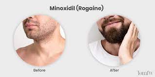 When will i see results? Minoxidil Beard Review Rogaine Before And After Tomfw